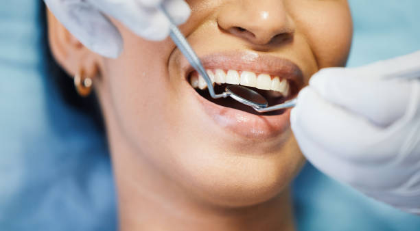 Best Emergency Dentist for Lost Fillings or Crowns in Duluth, WA