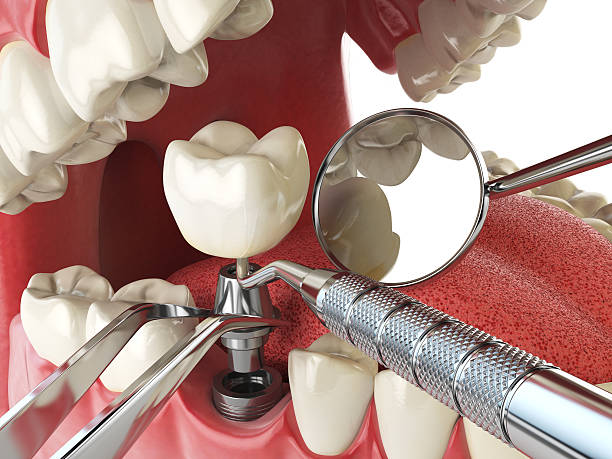 Best Broken or Cracked Tooth Emergency Dentist in Duluth, WA